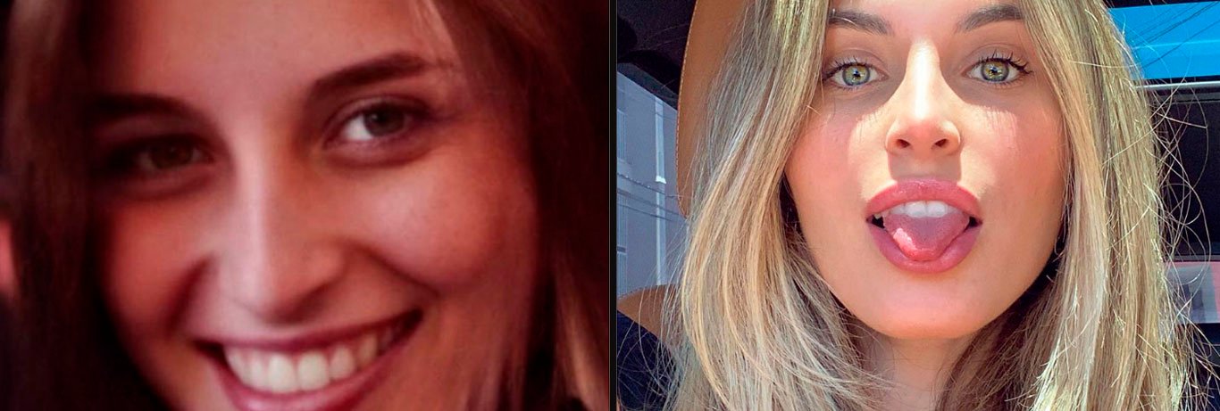 mulher loira mostra seu antes e depois da harmonização facial onde empinou o nariz e aumentou os lábios