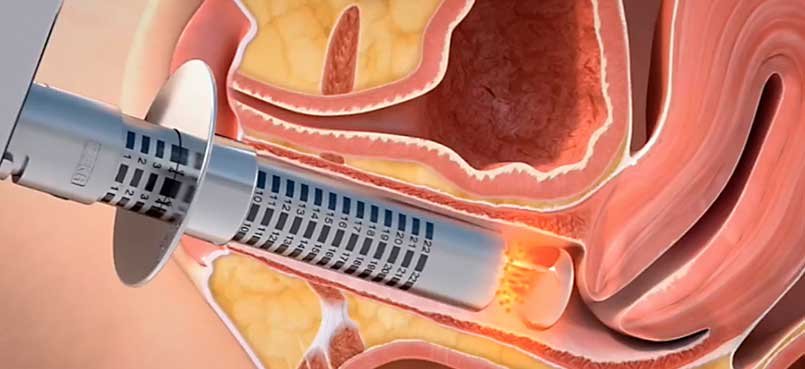 aparelho de laser sendo inserido no canal vaginal para tratamento da atrofia