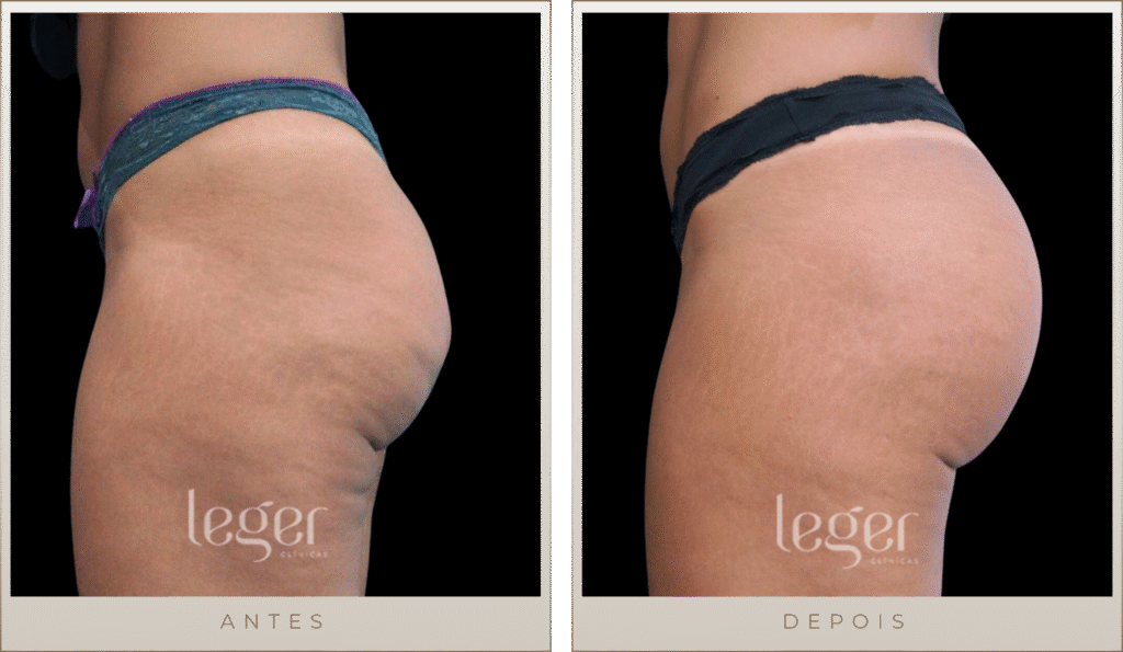 Resultado - Bioplastia na região glútea (Clinica Leger)