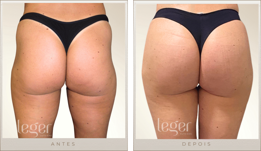 Antes e Depois - Bioplastia na região glútea (Foto 03)
