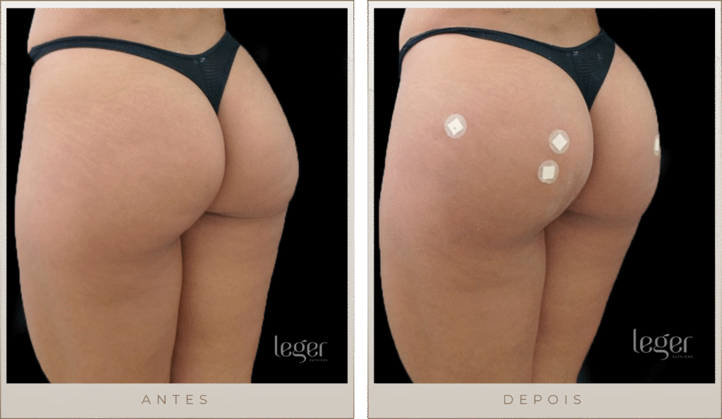 Antes e Depois - Bioplastia na região glútea (Foto 02)